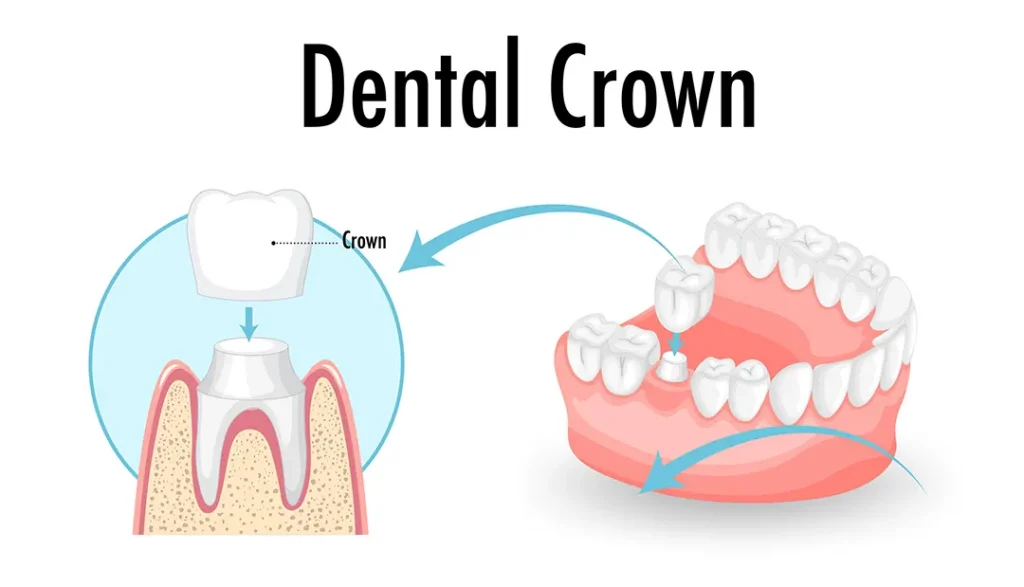 Tooth restored with a crown